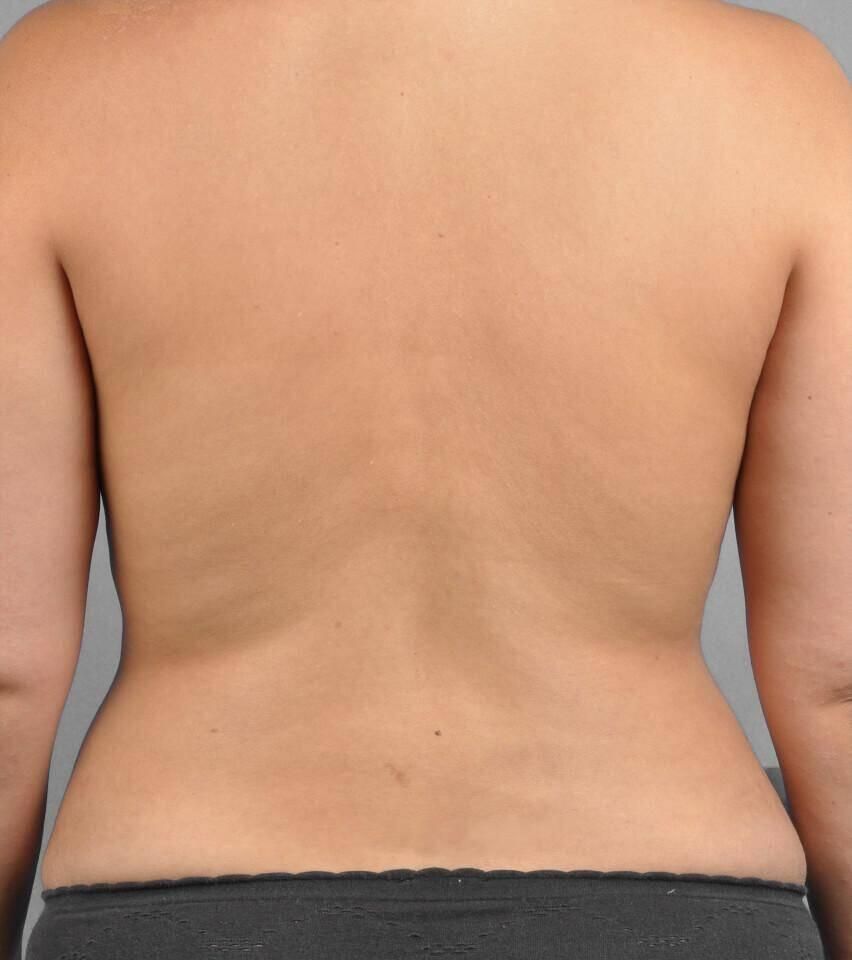 Liposuction Before & After
