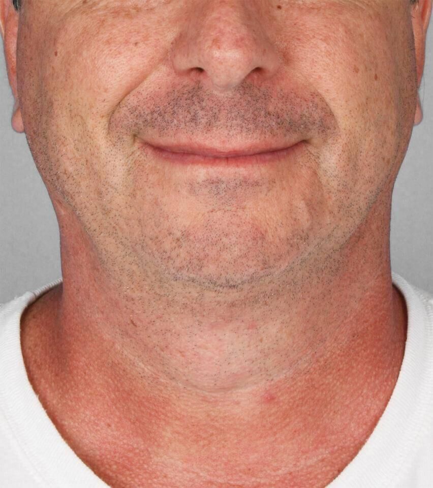 Liposuction Before & After