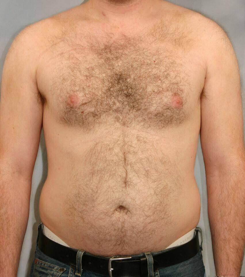 Liposuction Before & After