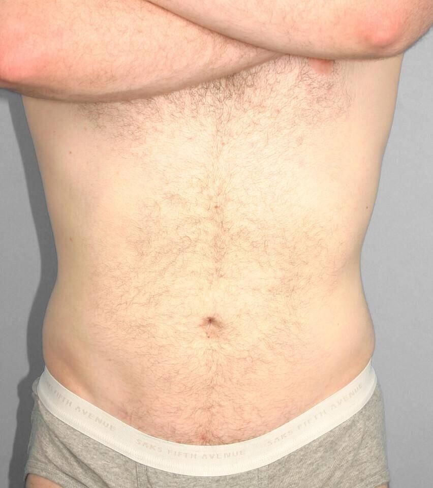 Liposuction Before & After