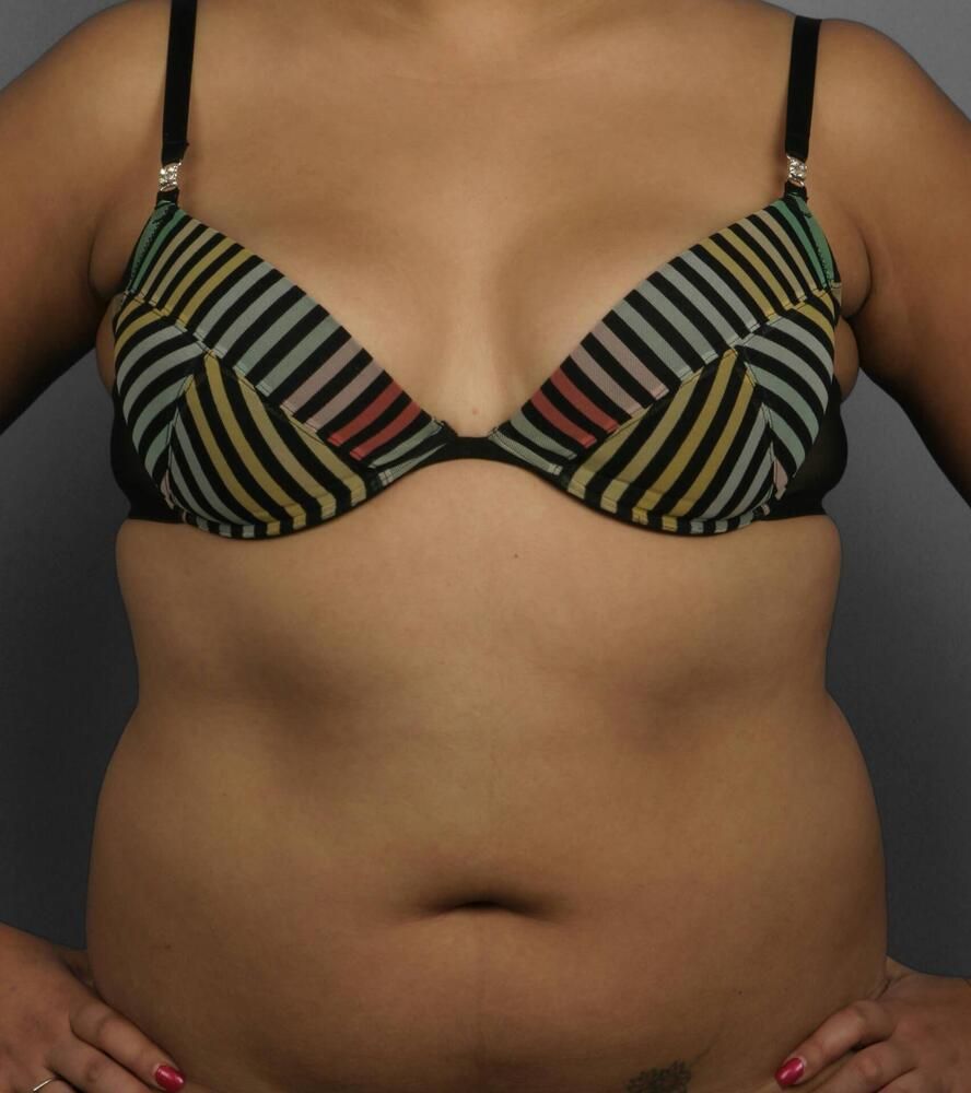 Liposuction Before & After