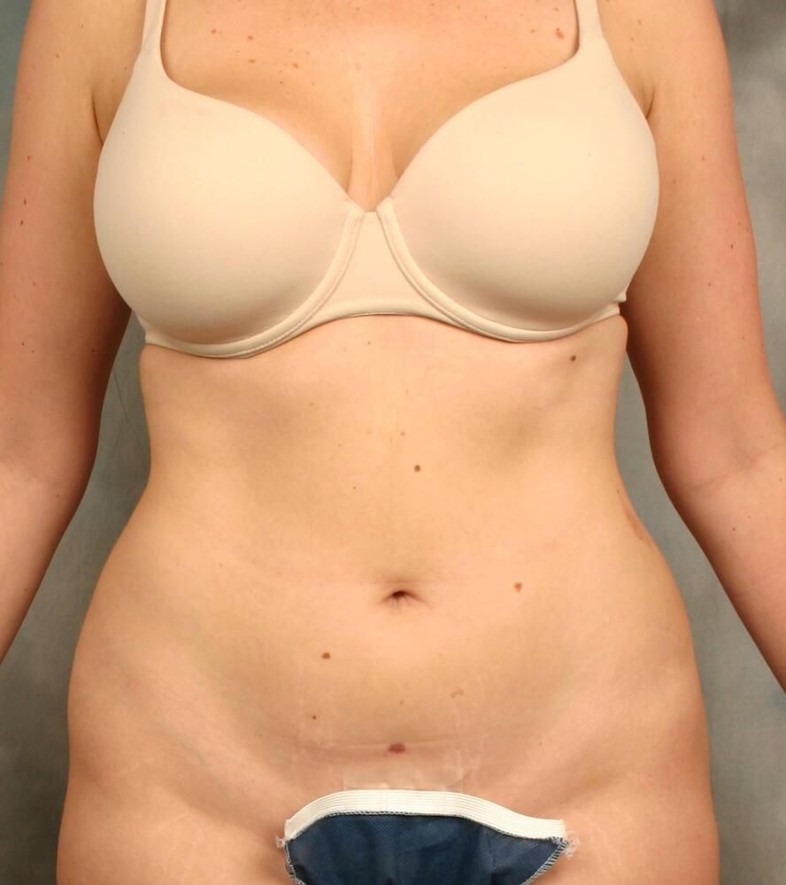 Liposuction Before & After