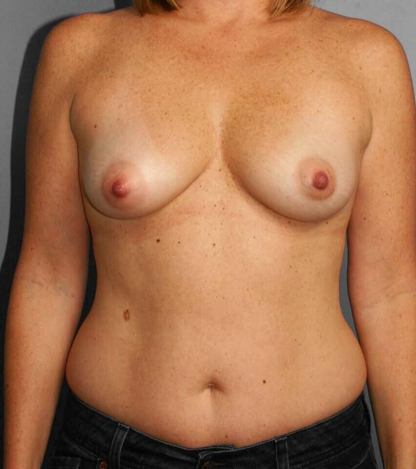 Liposuction Before & After