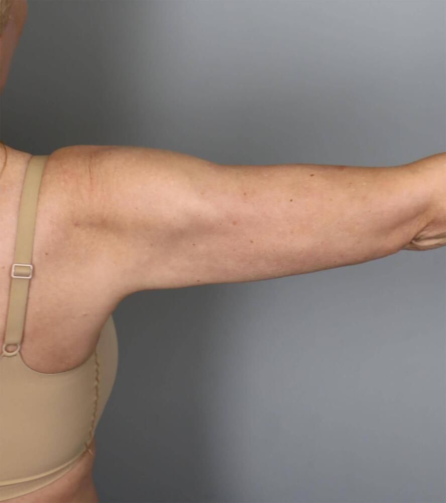 Liposuction Before & After