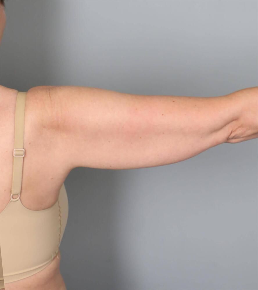 Liposuction Before & After