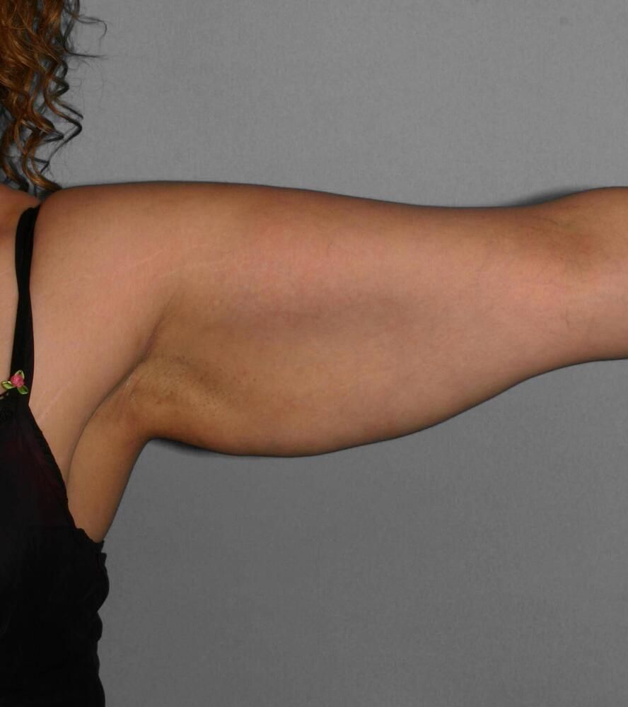 Liposuction Before & After