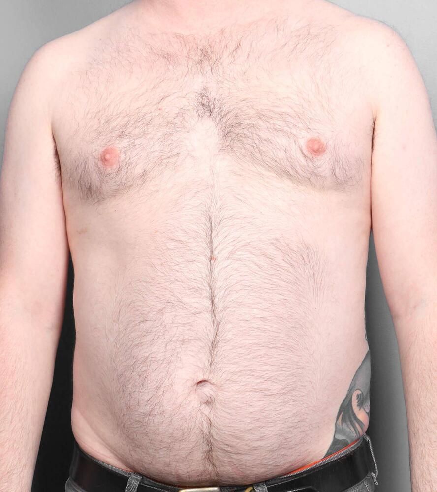 Liposuction Before & After