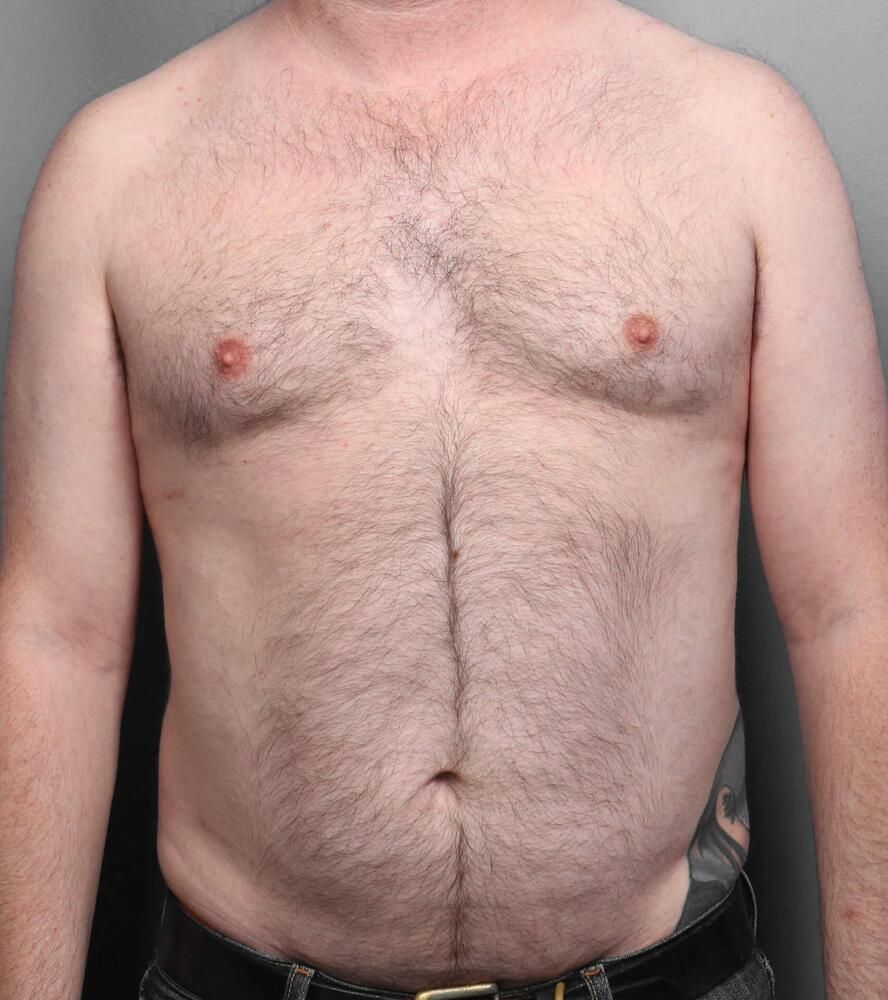 Liposuction Before & After