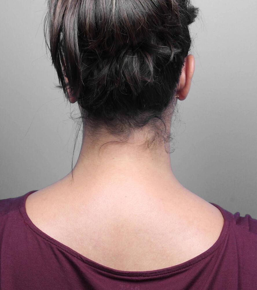 Liposuction Before & After