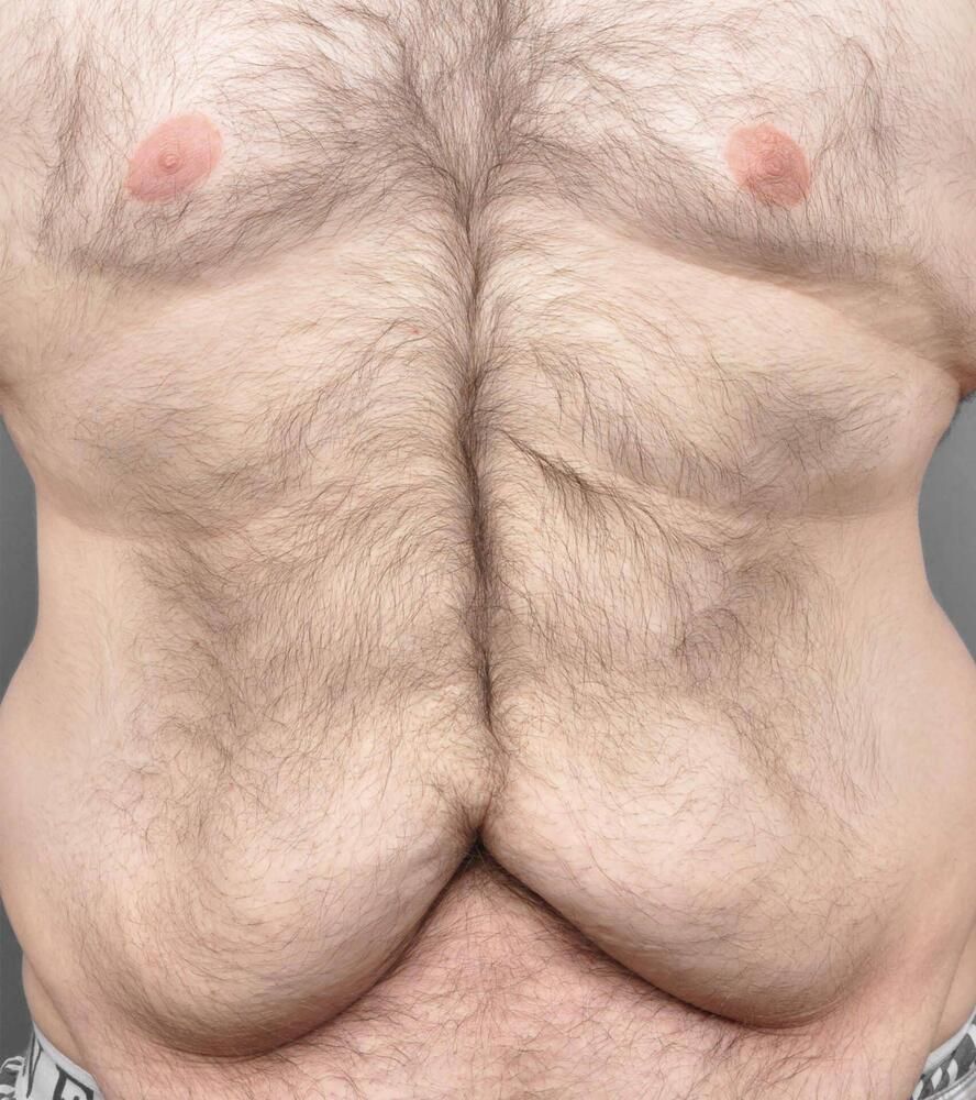 Tummy Tuck Before & After