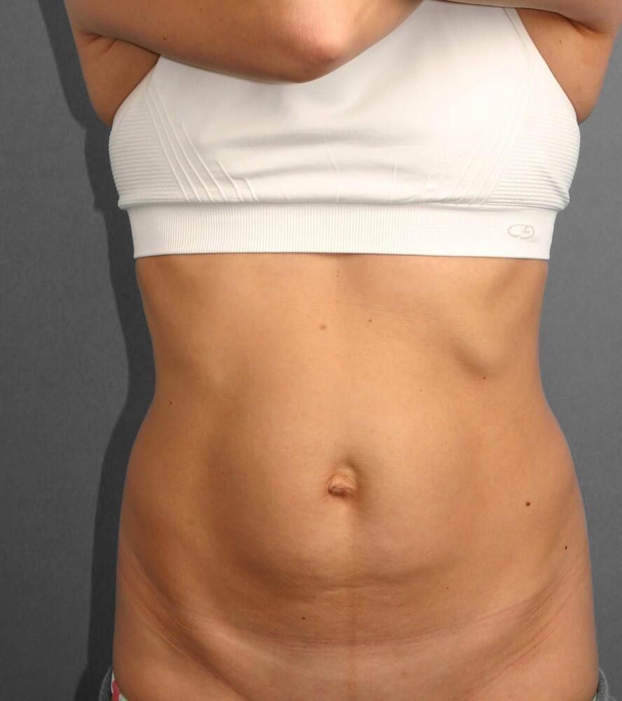 Tummy Tuck Before & After