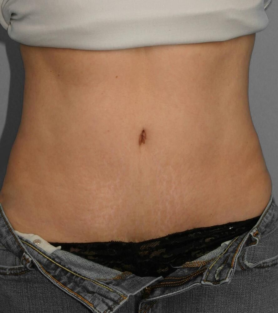 Tummy Tuck Before & After