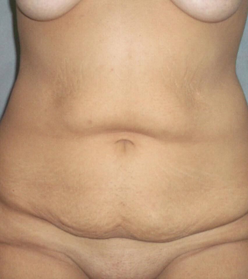 Tummy Tuck Before & After