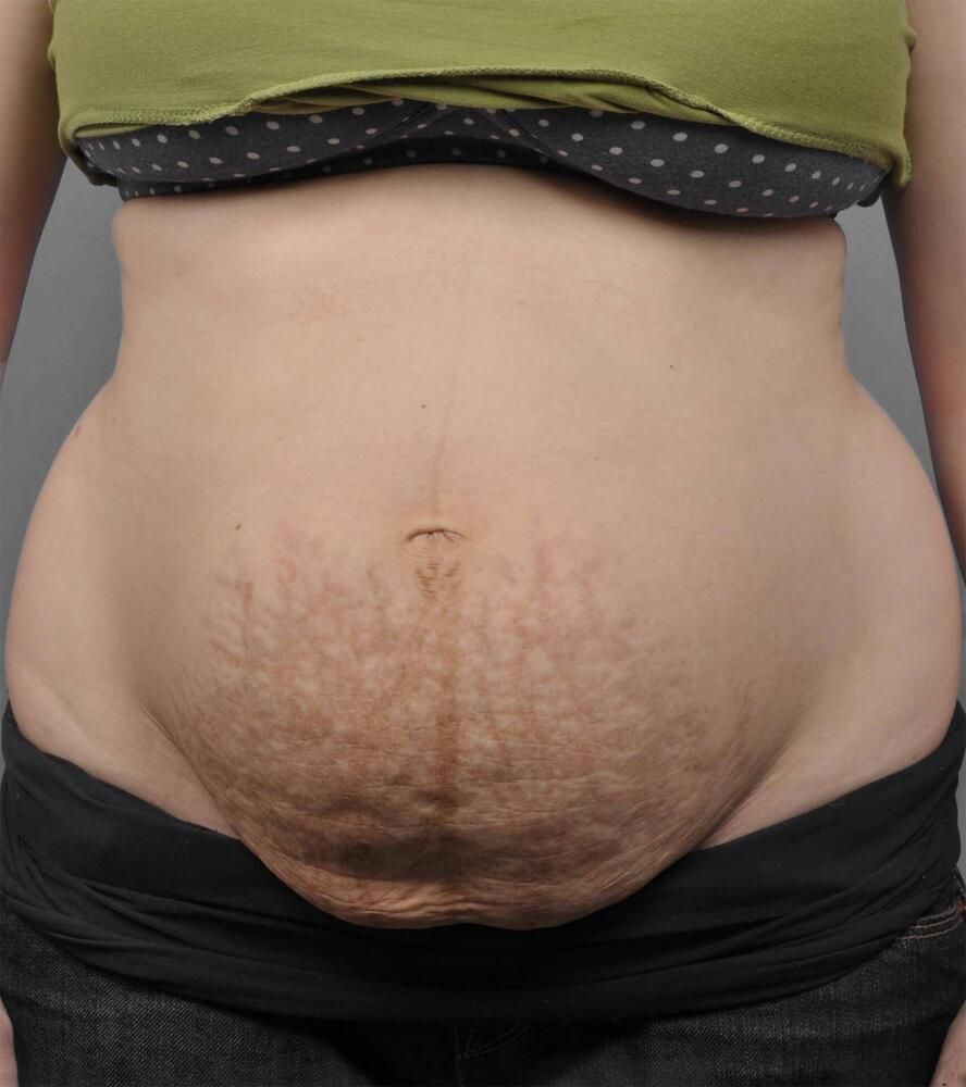 Tummy Tuck Before & After