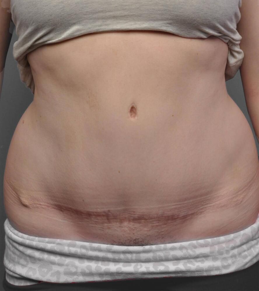 Tummy Tuck Before & After