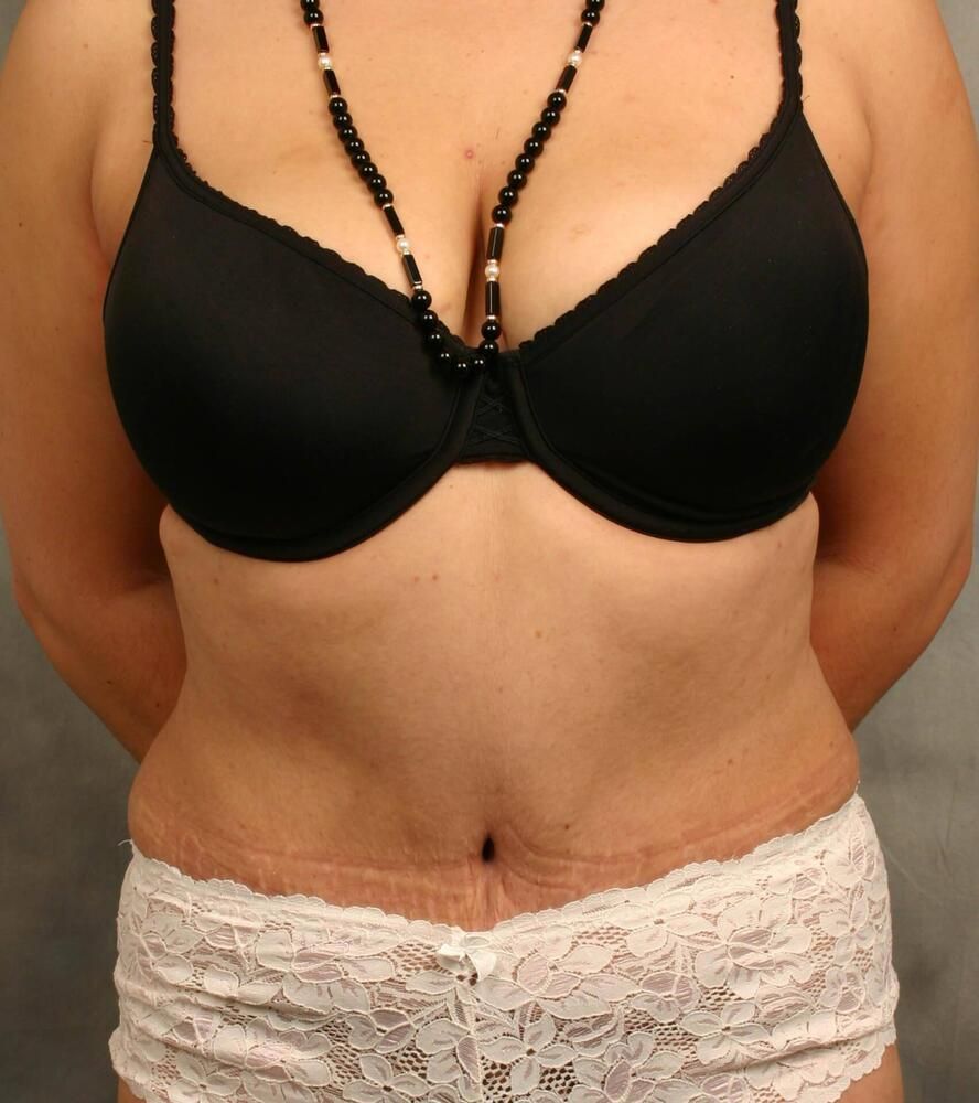 Tummy Tuck Before & After
