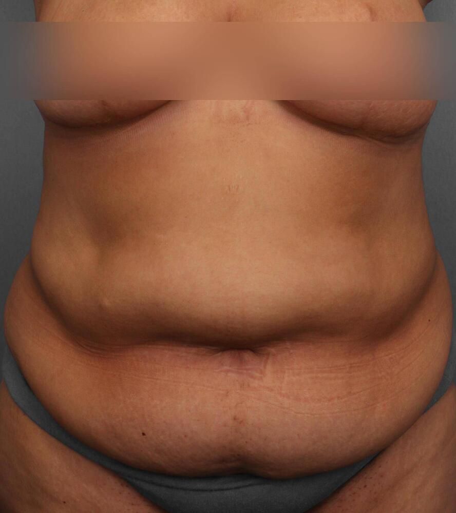 Tummy Tuck Before & After