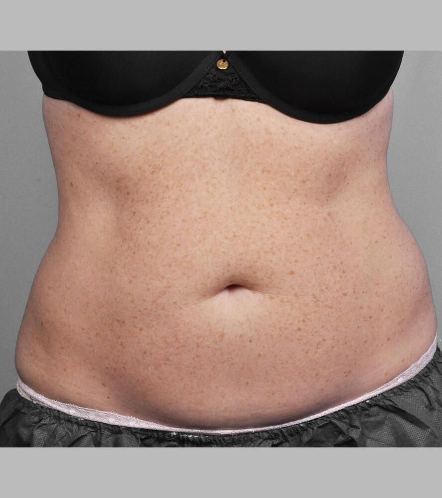 Coolsculpting Before & After