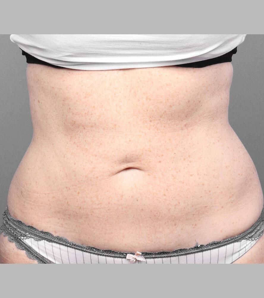 Coolsculpting Before & After