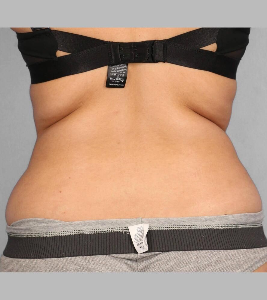 Coolsculpting Before & After