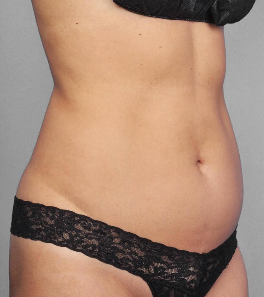 Coolsculpting Before & After