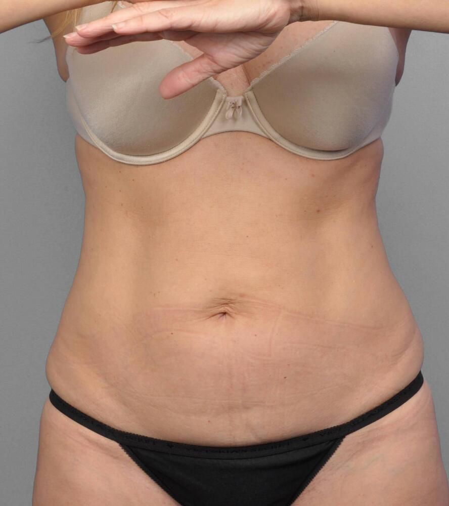 Coolsculpting Before & After