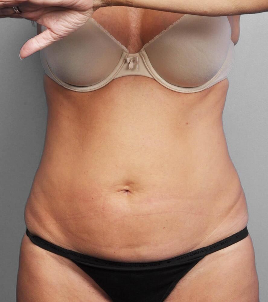 Coolsculpting Before & After