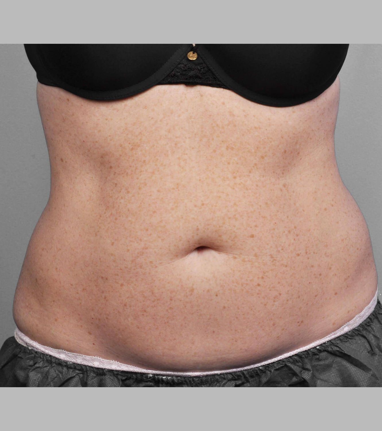 Coolsculpting Before & After