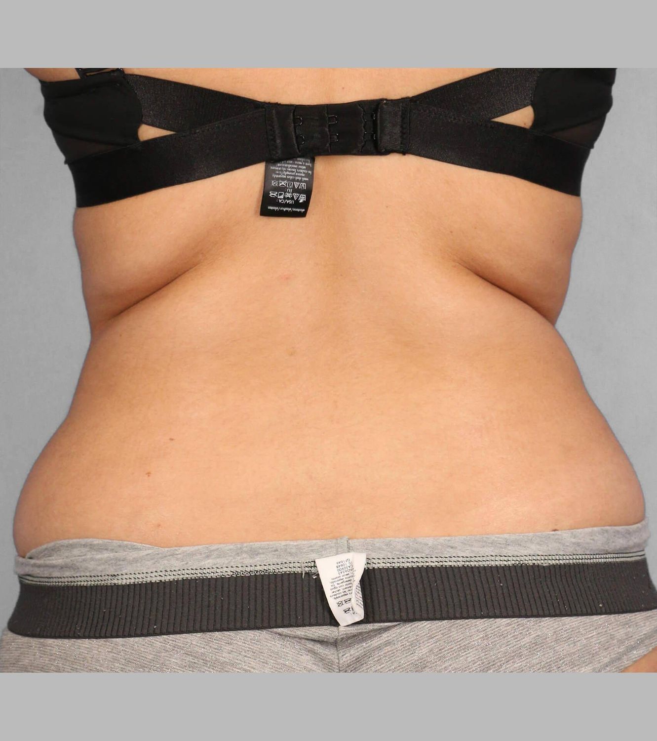 Coolsculpting Before & After