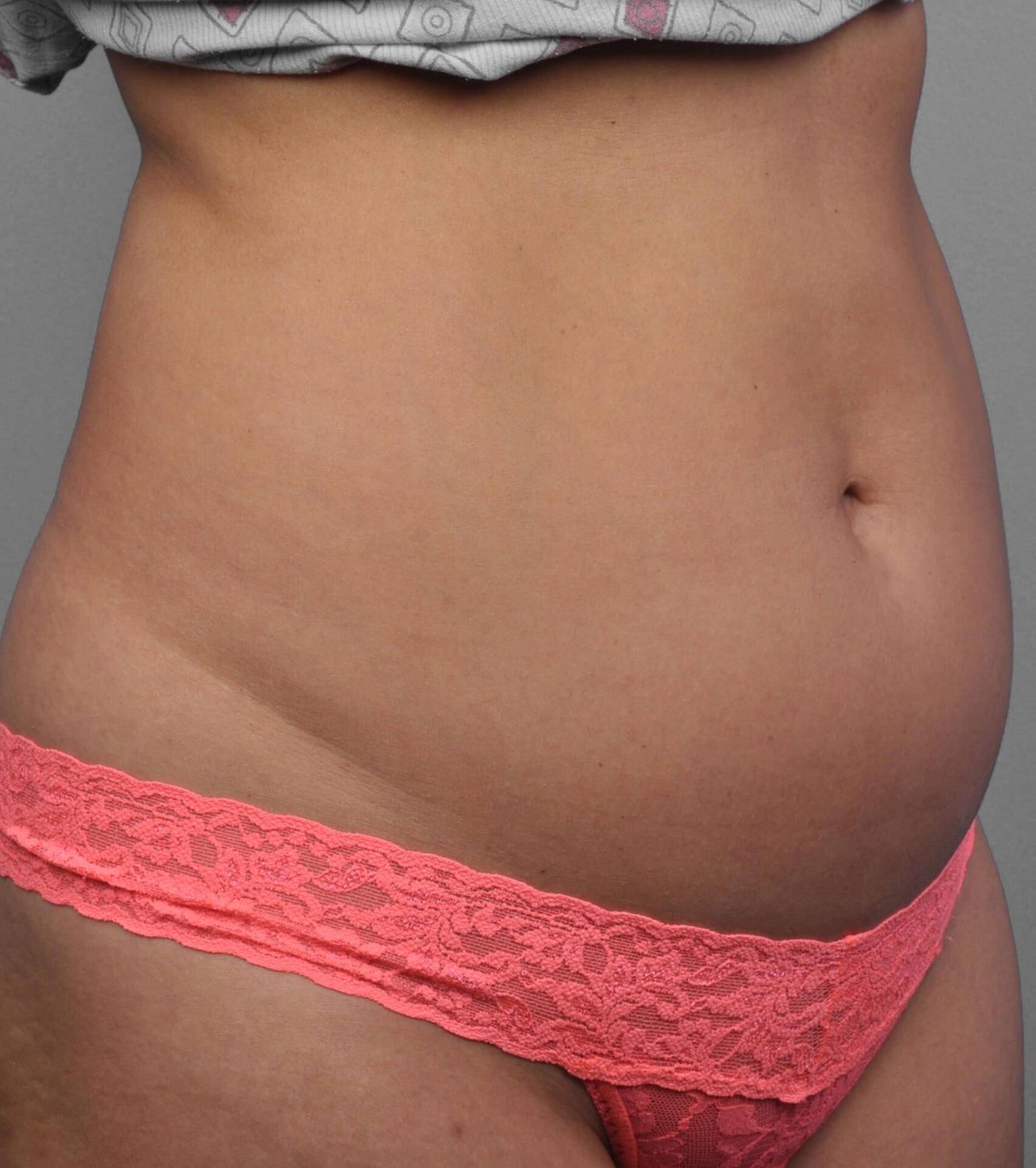 Coolsculpting Before & After