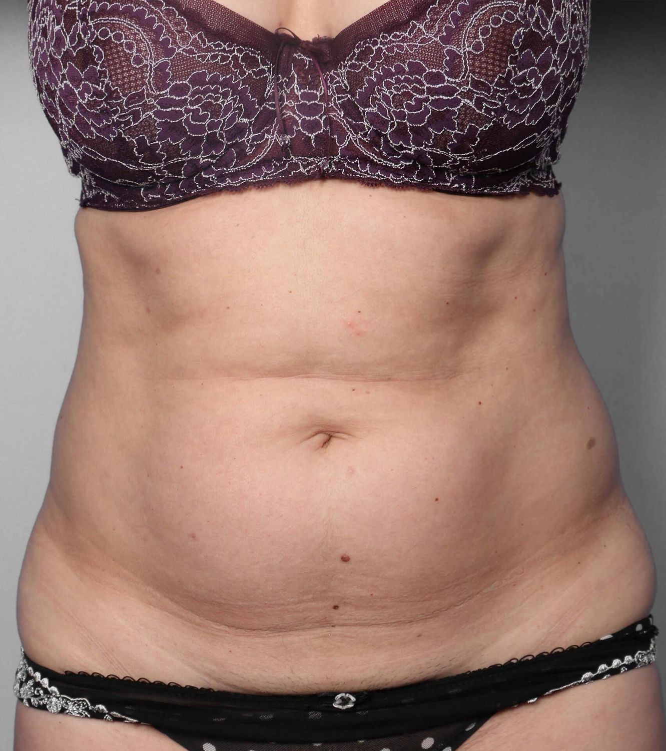 Liposuction Before & After
