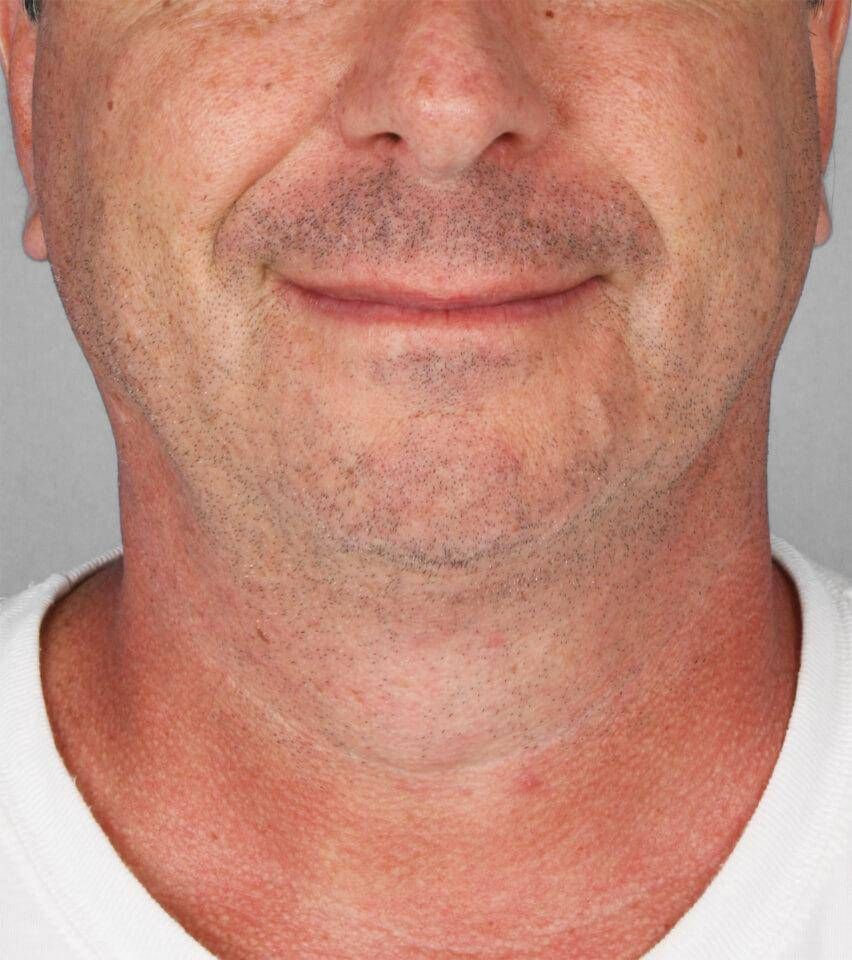 Liposuction Before & After