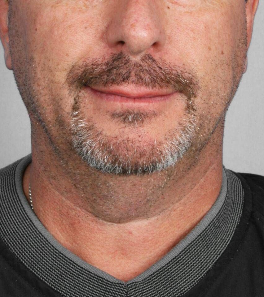 Liposuction Before & After