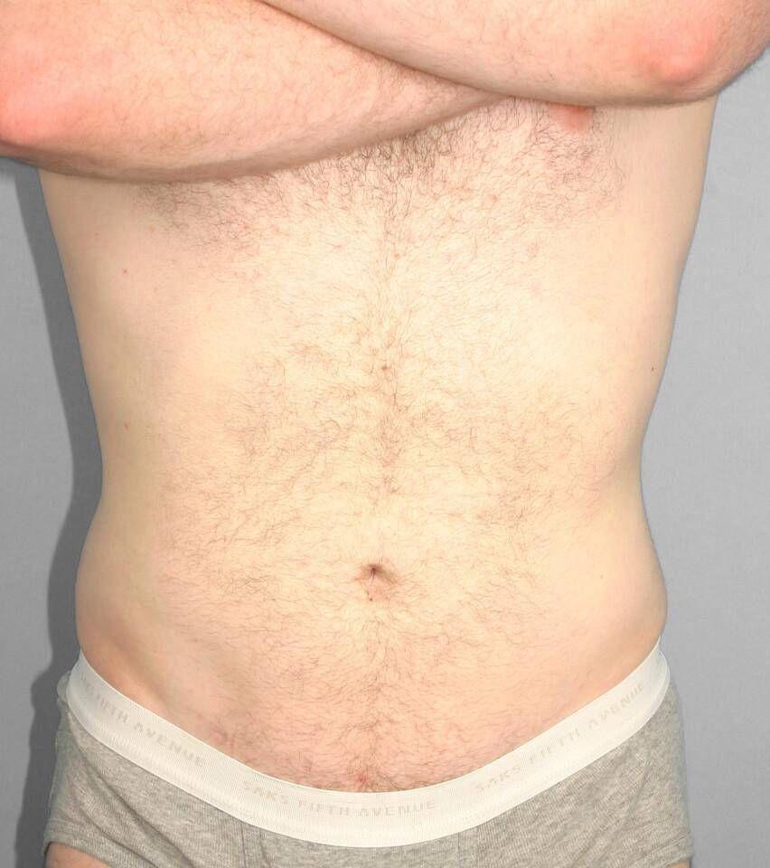 Liposuction Before & After