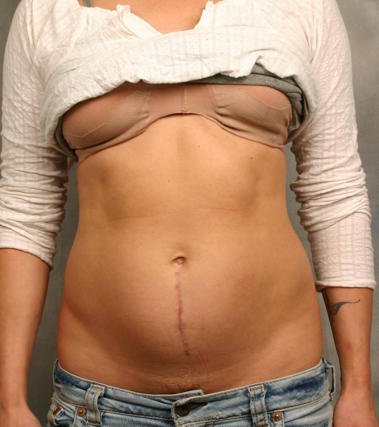 Liposuction Before & After