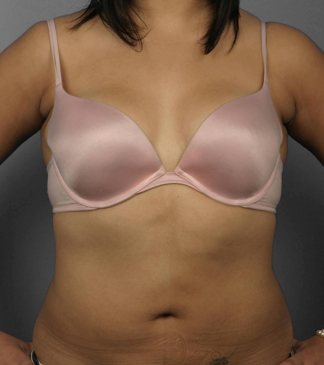 Liposuction Before & After