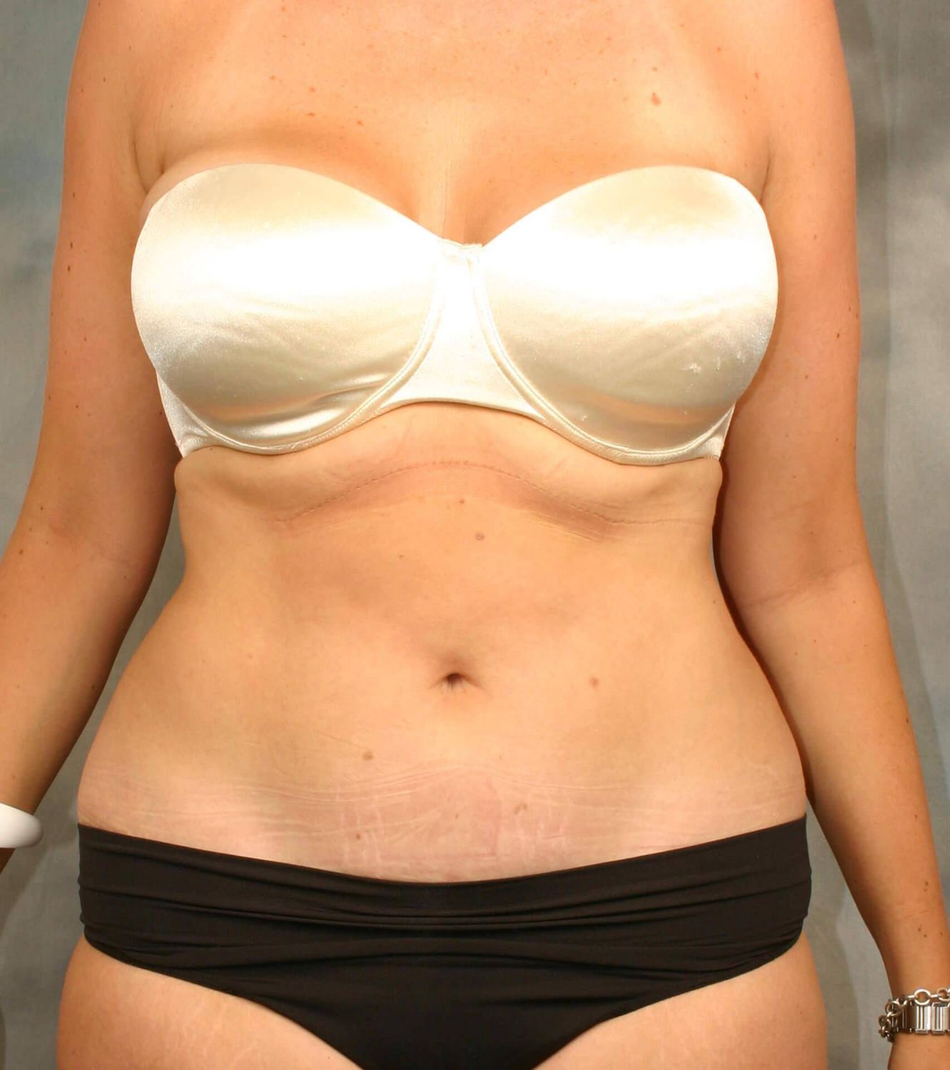 Liposuction Before & After