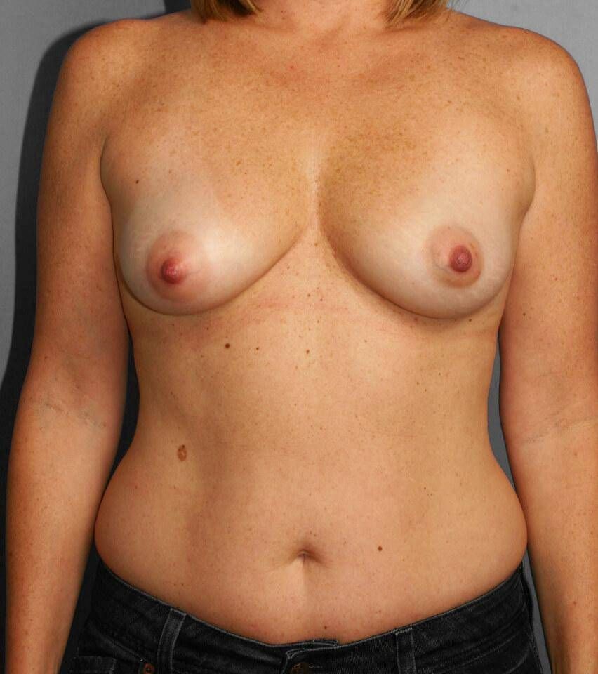 Liposuction Before & After