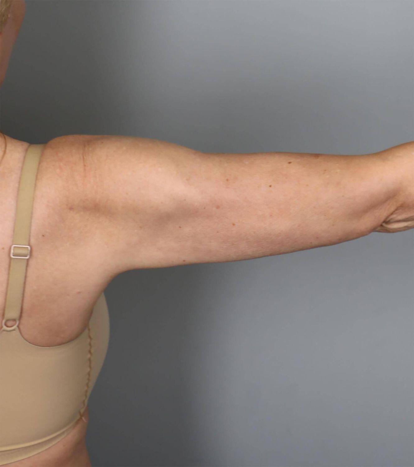 Liposuction Before & After