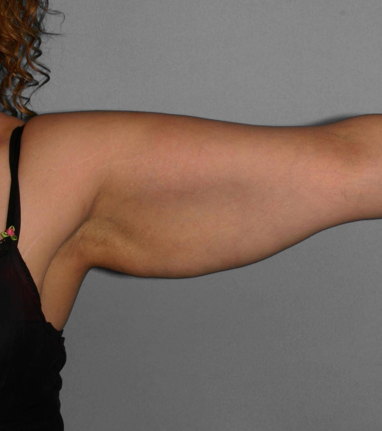 Liposuction Before & After