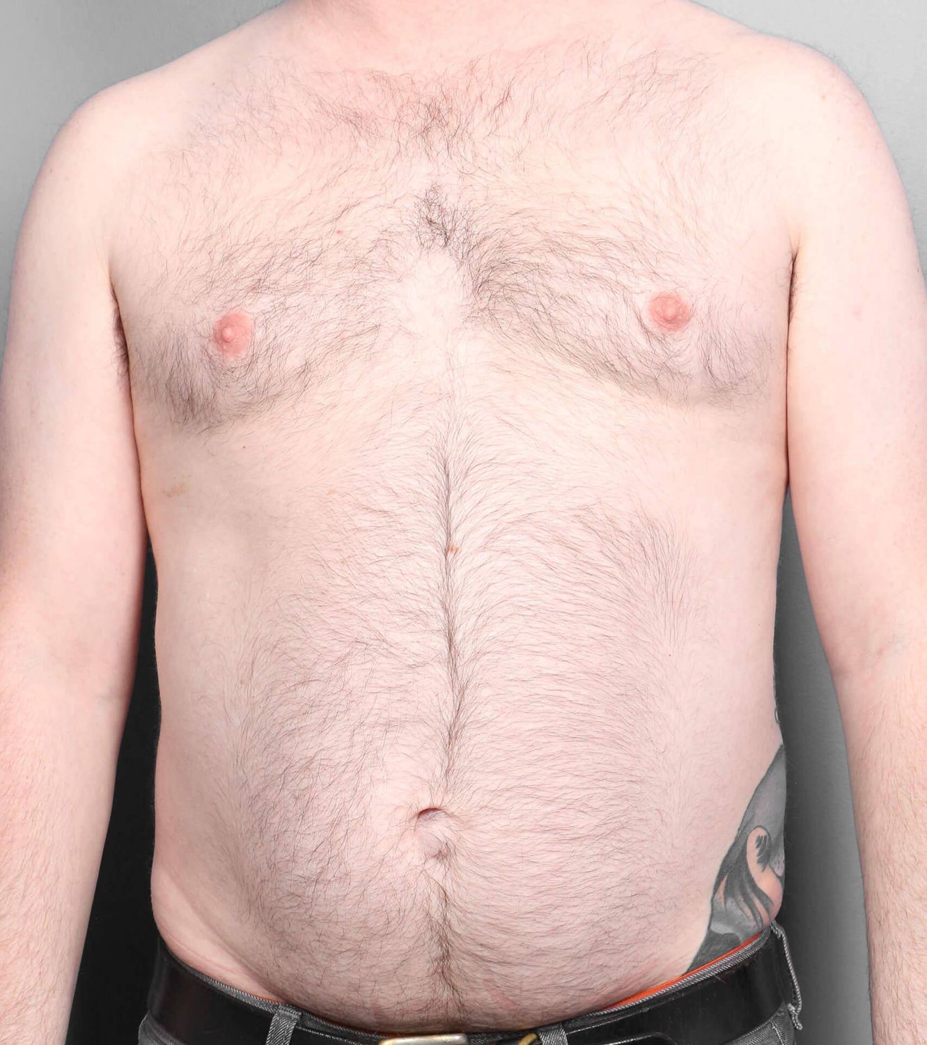 Liposuction Before & After