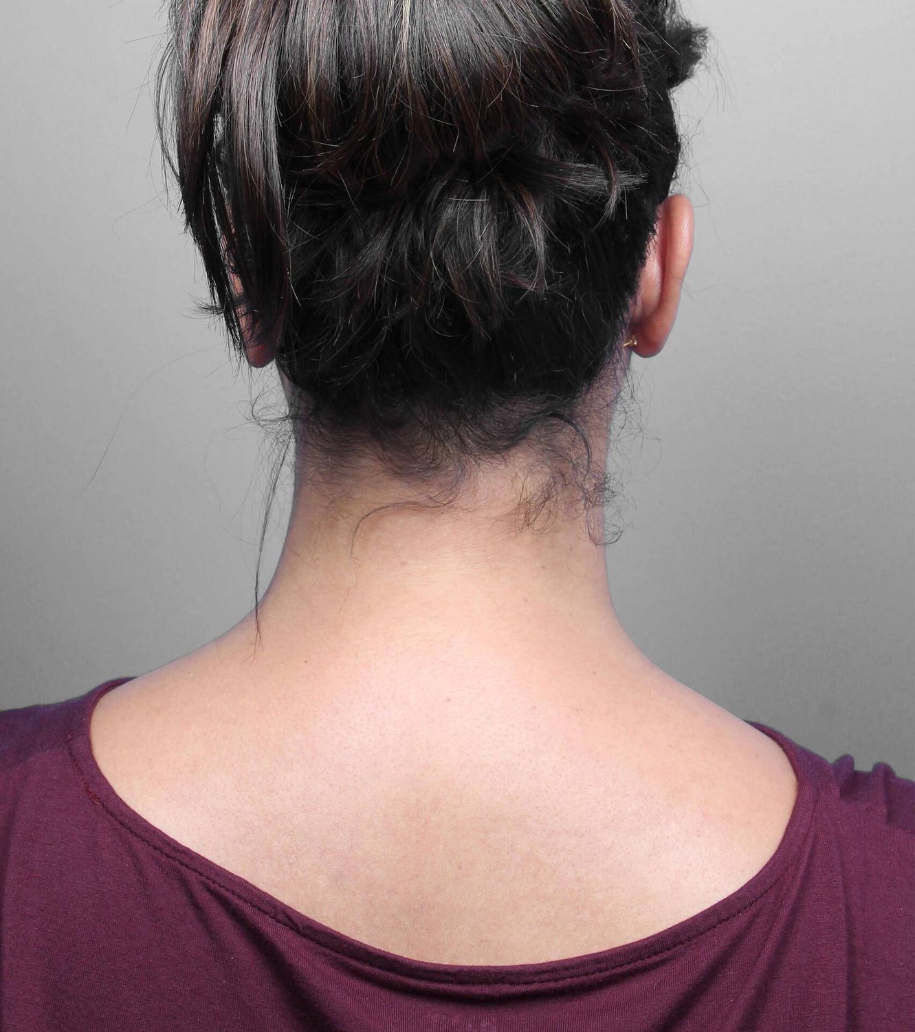 Liposuction Before & After