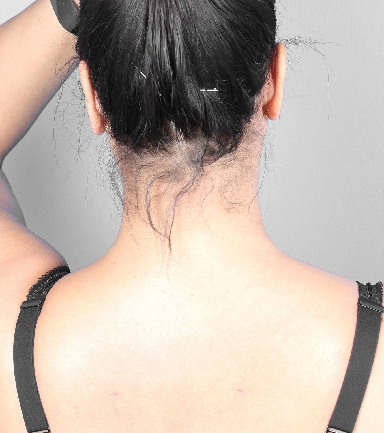 Liposuction Before & After