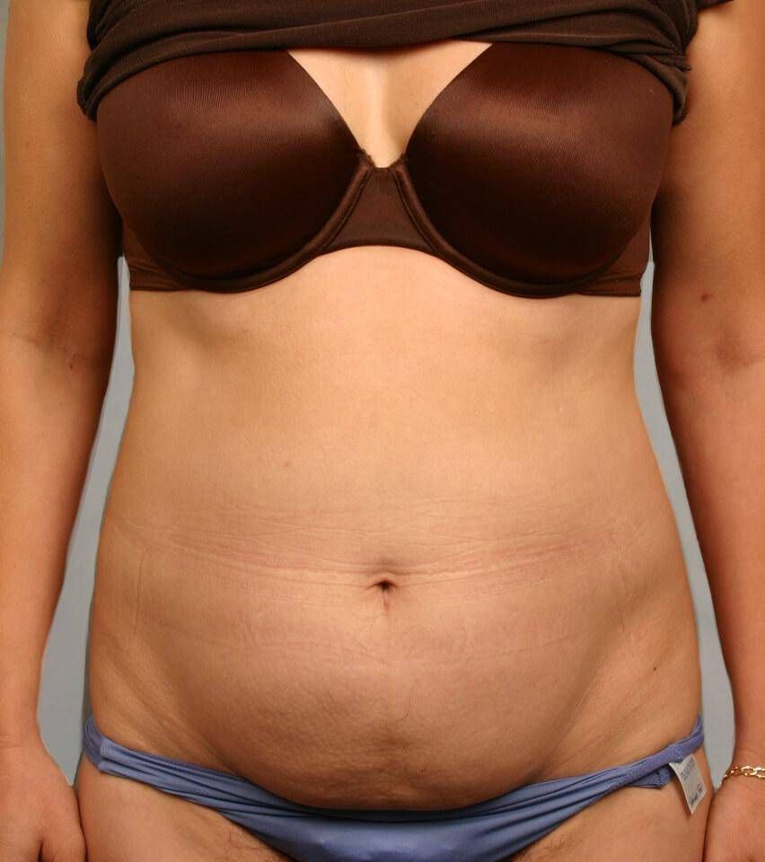 Tummy Tuck Before & After