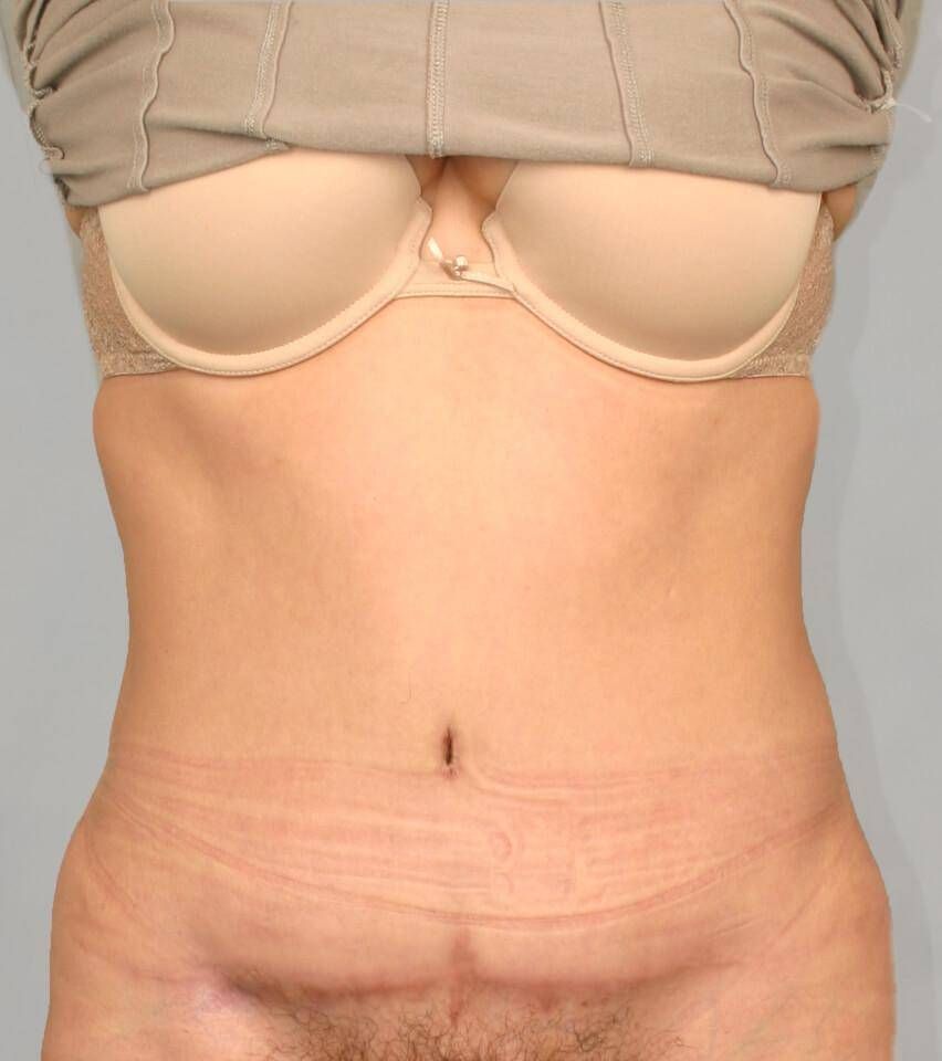 Tummy Tuck Before & After