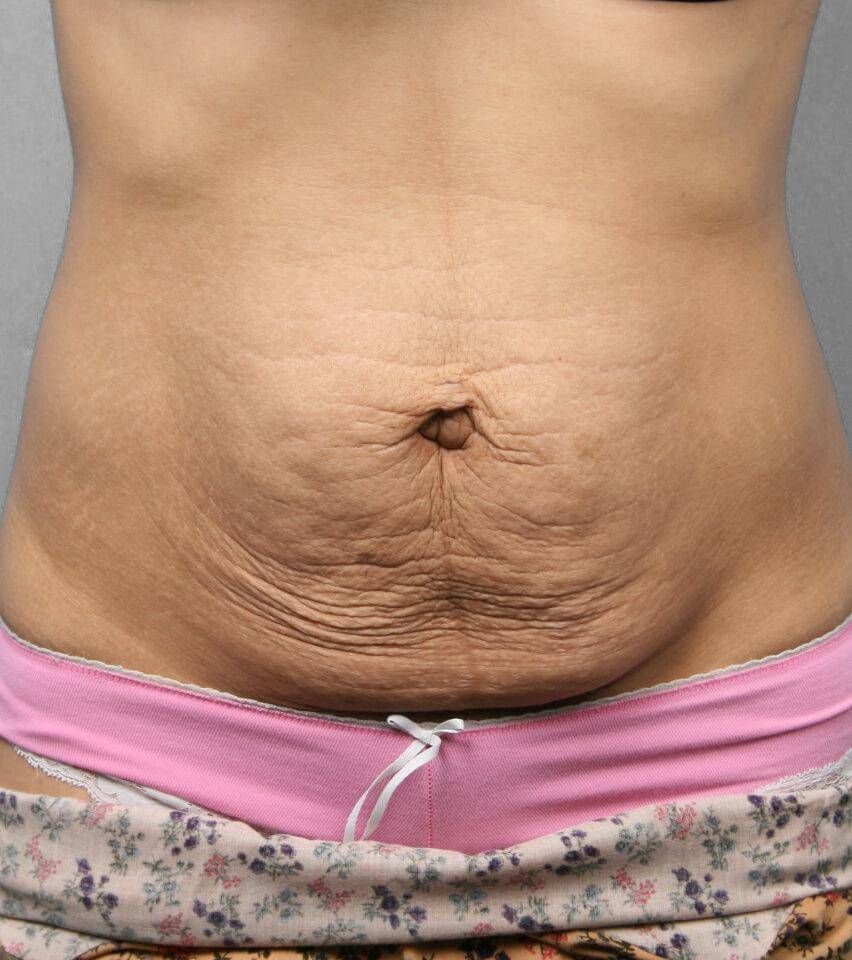Tummy Tuck Before & After