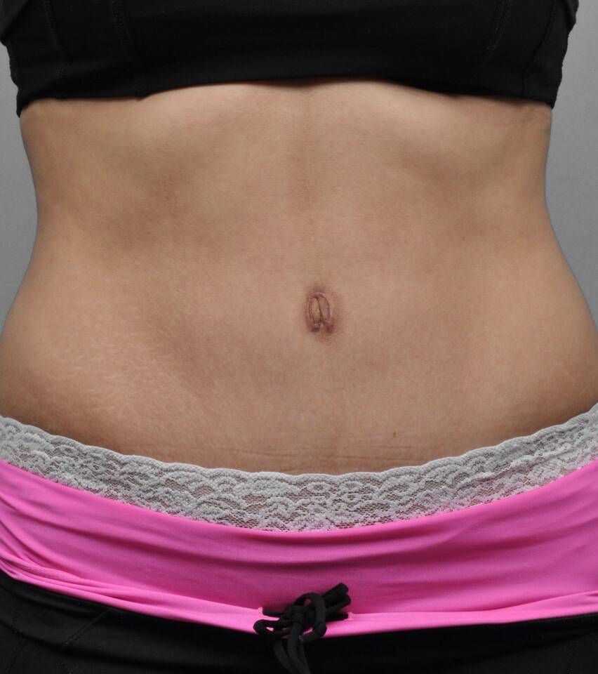 Tummy Tuck Before & After