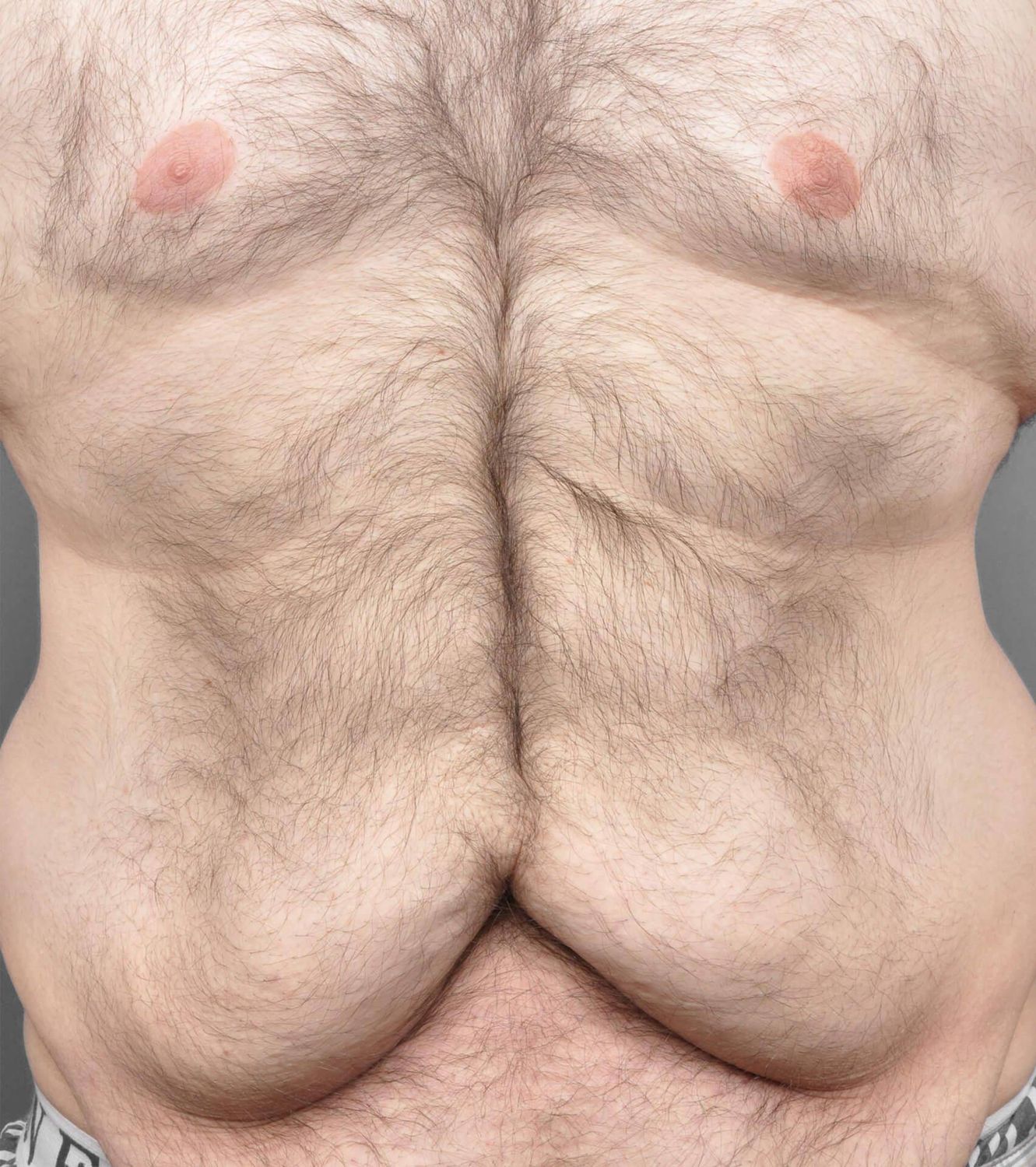 Tummy Tuck Before & After