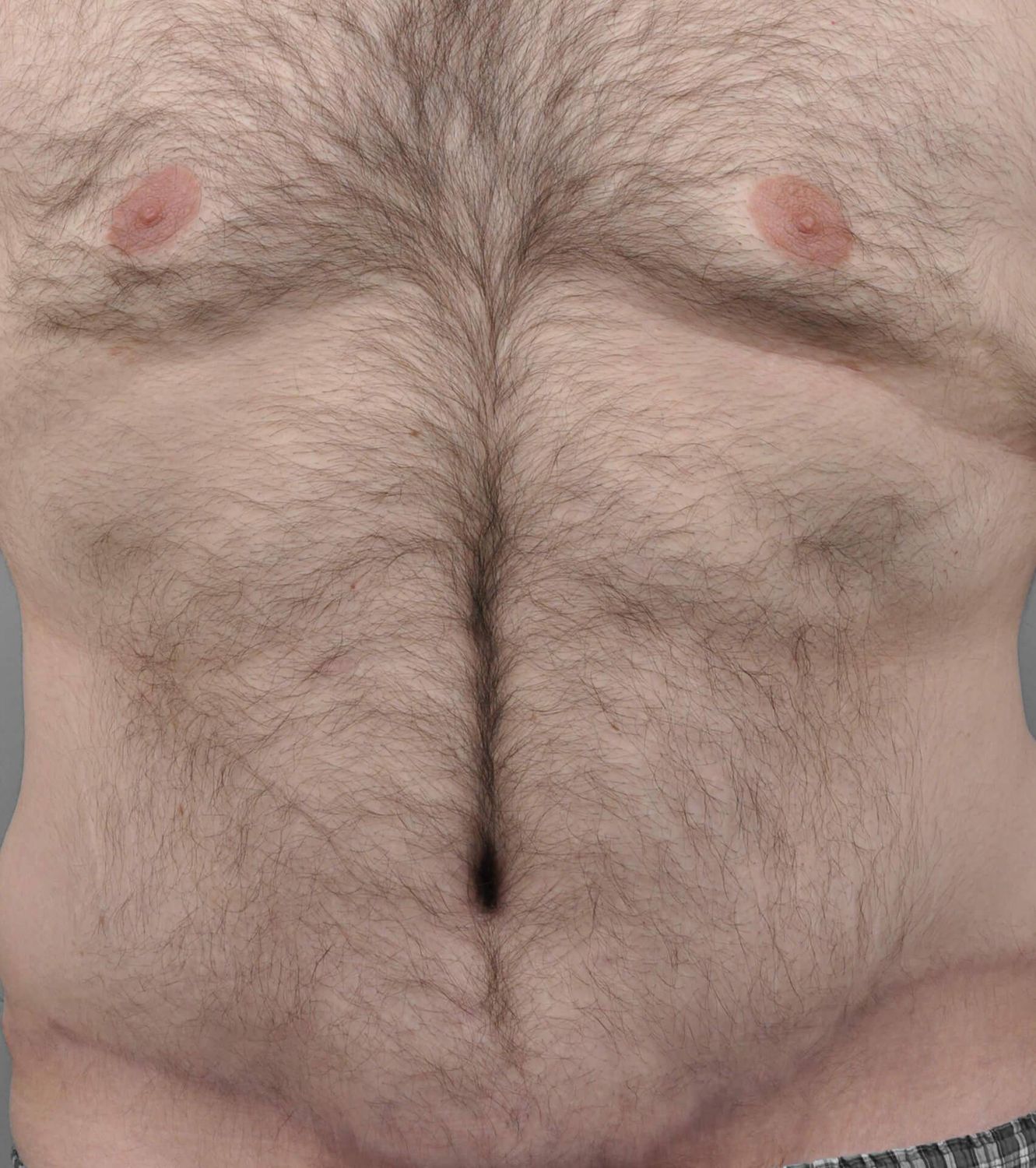 Tummy Tuck Before & After