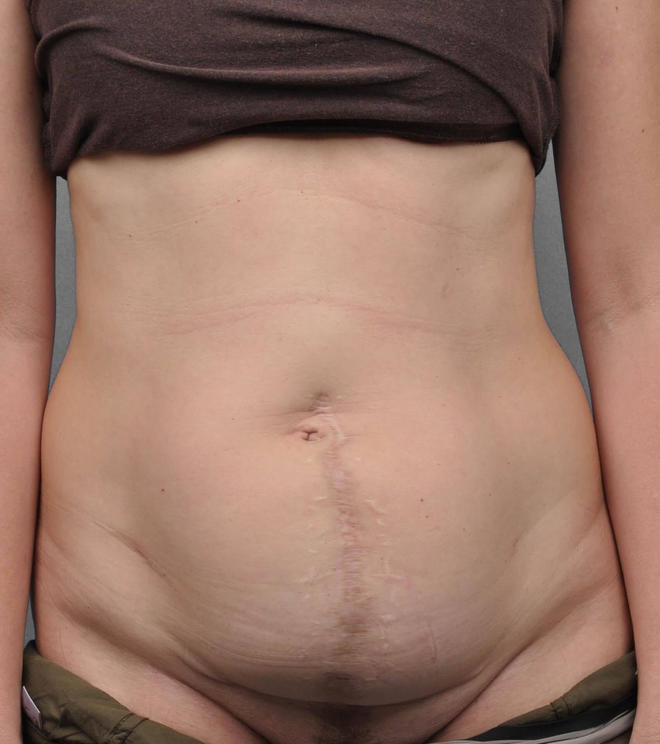 Tummy Tuck Before & After